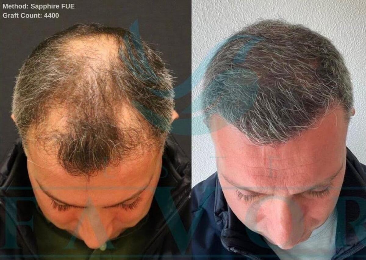Labeled before and after photos of an Este Favor patient (Sapphire FUE, 4,400 grafts) published in a press guide (LA Times special section).
