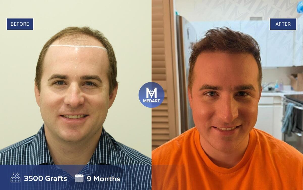 Labeled before and after photos of a Medart Hair patient (3,500 grafts, 9 months) published in a press guide (LA Times).