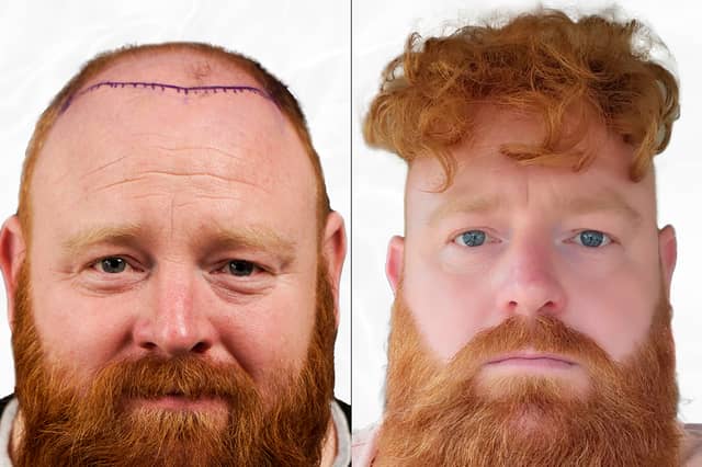 Before and after photos of a Vera Clinic patient published in a press article (The Scotsman).