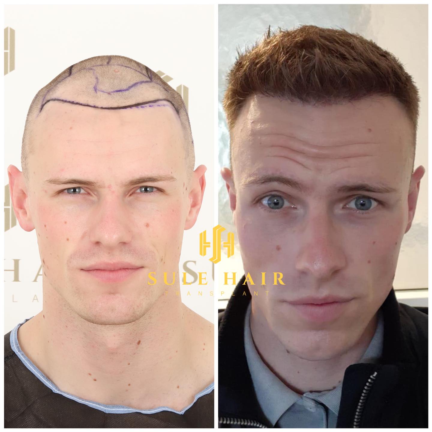 Labeled before and after photos published on Sule Hair Clinic's official website.