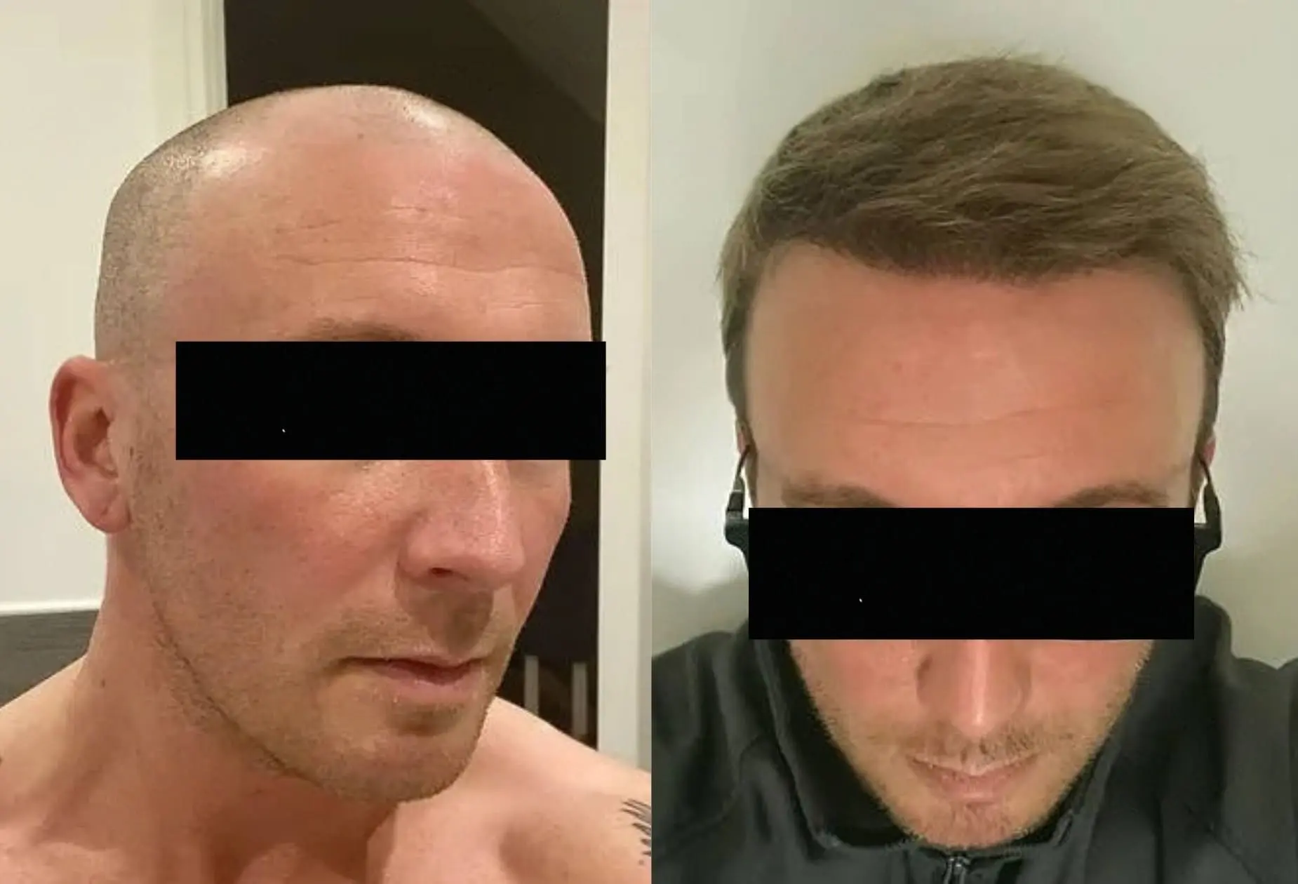 Before and after documentation of a Clinicana hair transplant patient (independent patient photo, Yapita Health review).