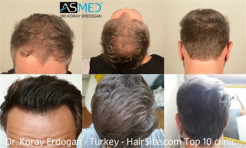 Documented before and after case collage of ASMED patients by Dr. Koray Erdogan (HairSite.com).