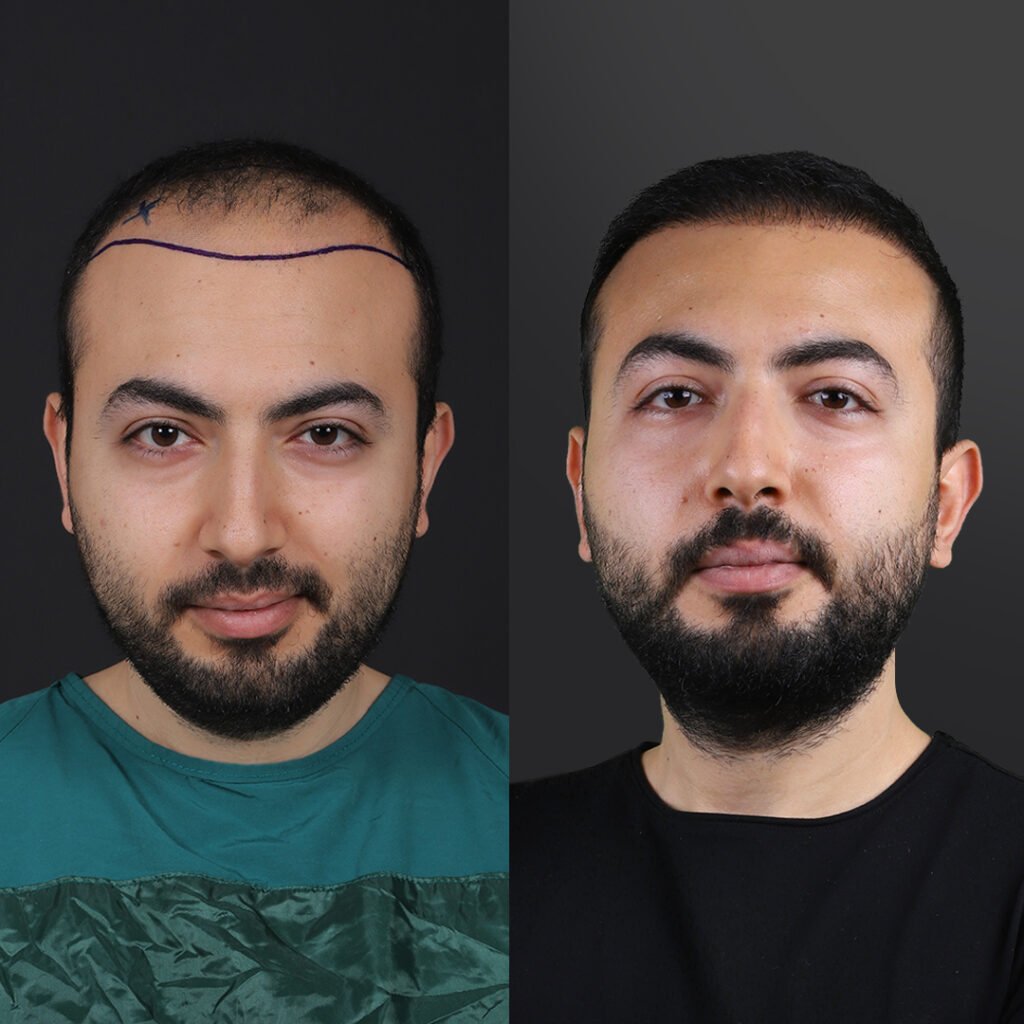 Before and after photos of an Elithair patient published in an independent review article (Turkey Health Magazin).