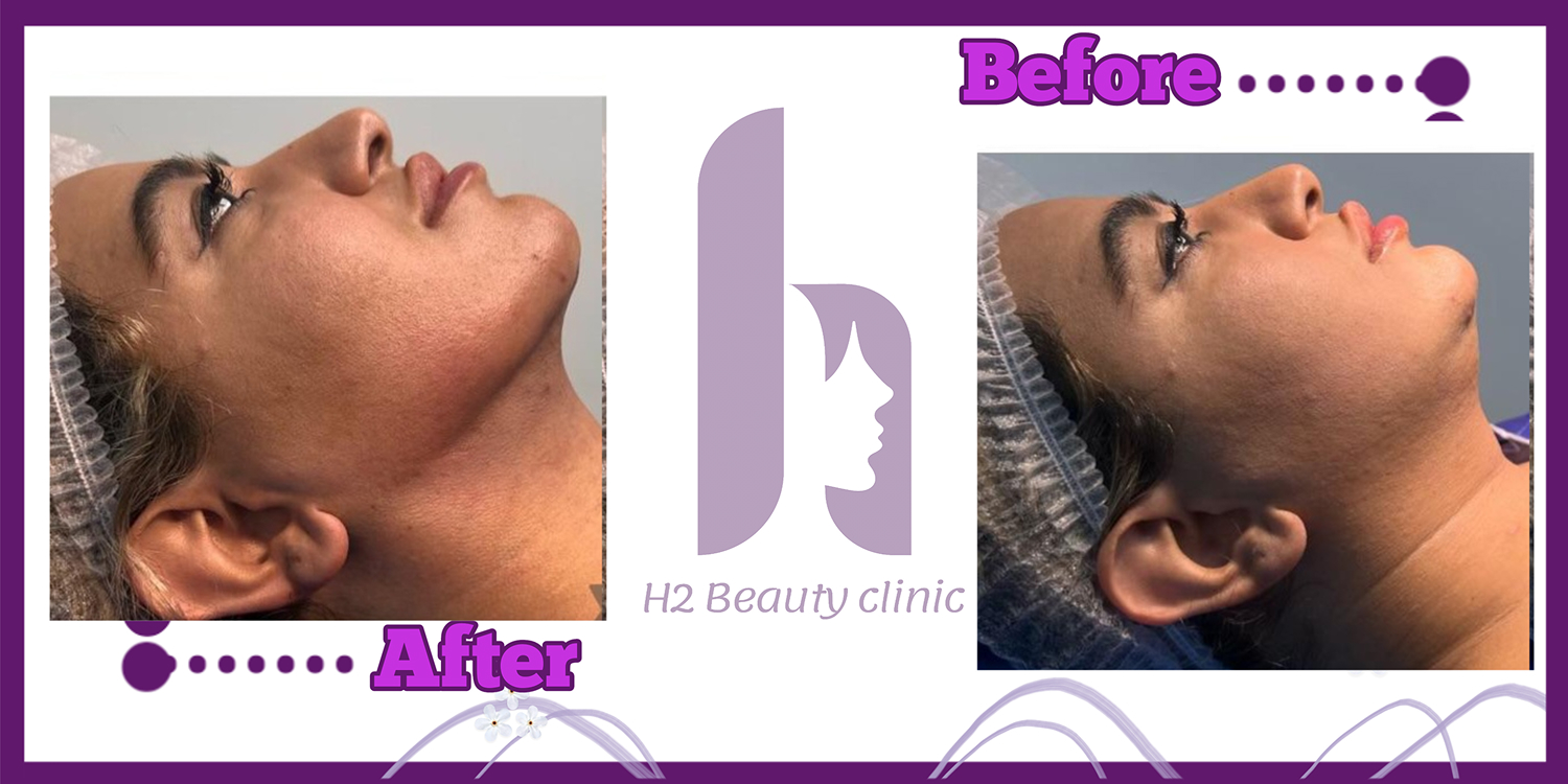Clinic H2 submental liposuction comparison five; provider labels after on the left and before on the right
