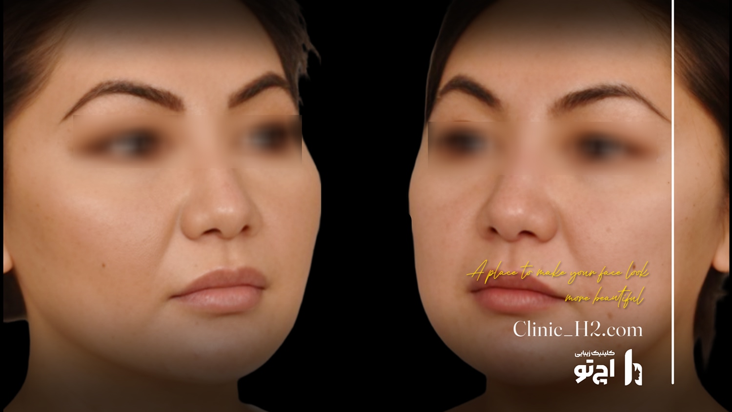 Clinic H2 published paired photograph for buccal fat removal; chronological sides not specified