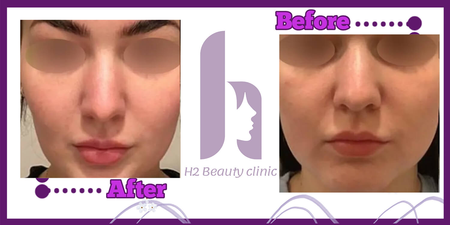 Clinic H2 buccal fat removal example; before at right and after at left