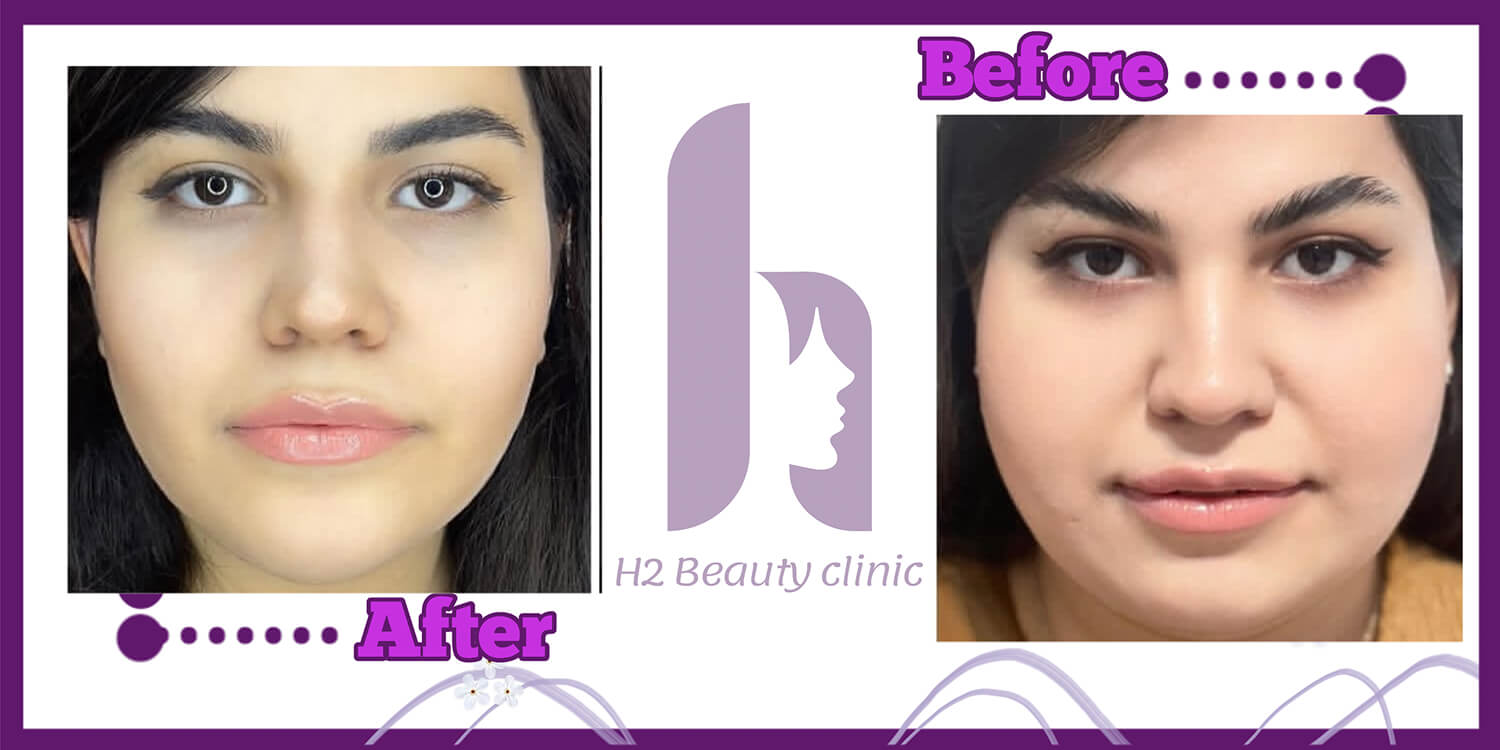 Clinic H2 buccal fat removal comparison; before at right and after at left