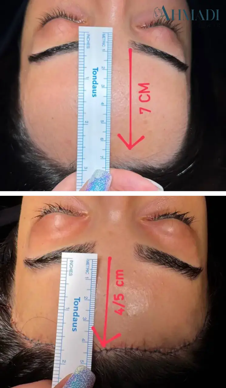 Dr Mehdi Ahmadi published paired hairline-lowering comparison with forehead measurements