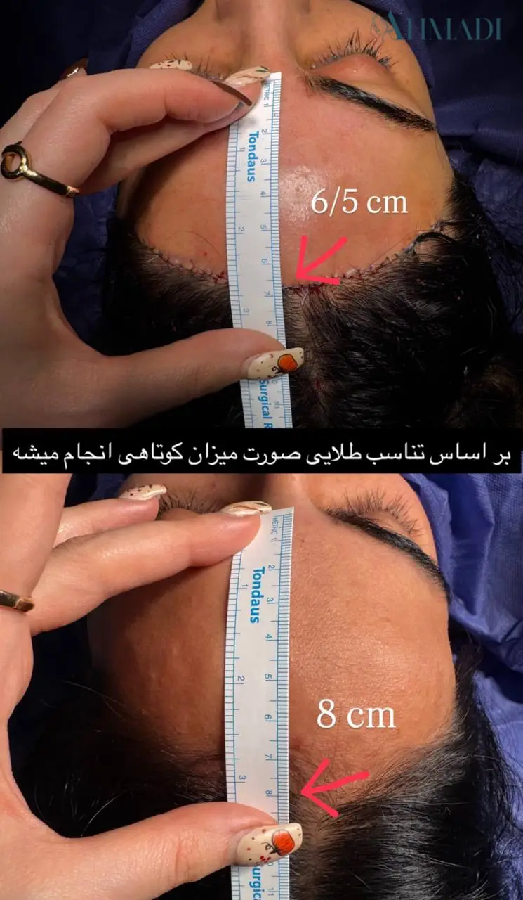 Dr Mehdi Ahmadi published before and after hairline-lowering comparison with ruler