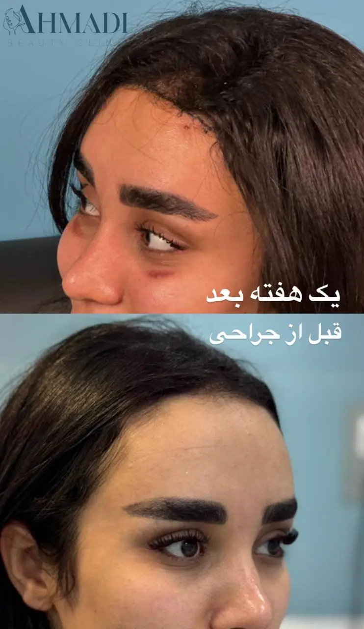 Before and one-week-after hairline shortening comparison published by Dr Mehdi Ahmadi