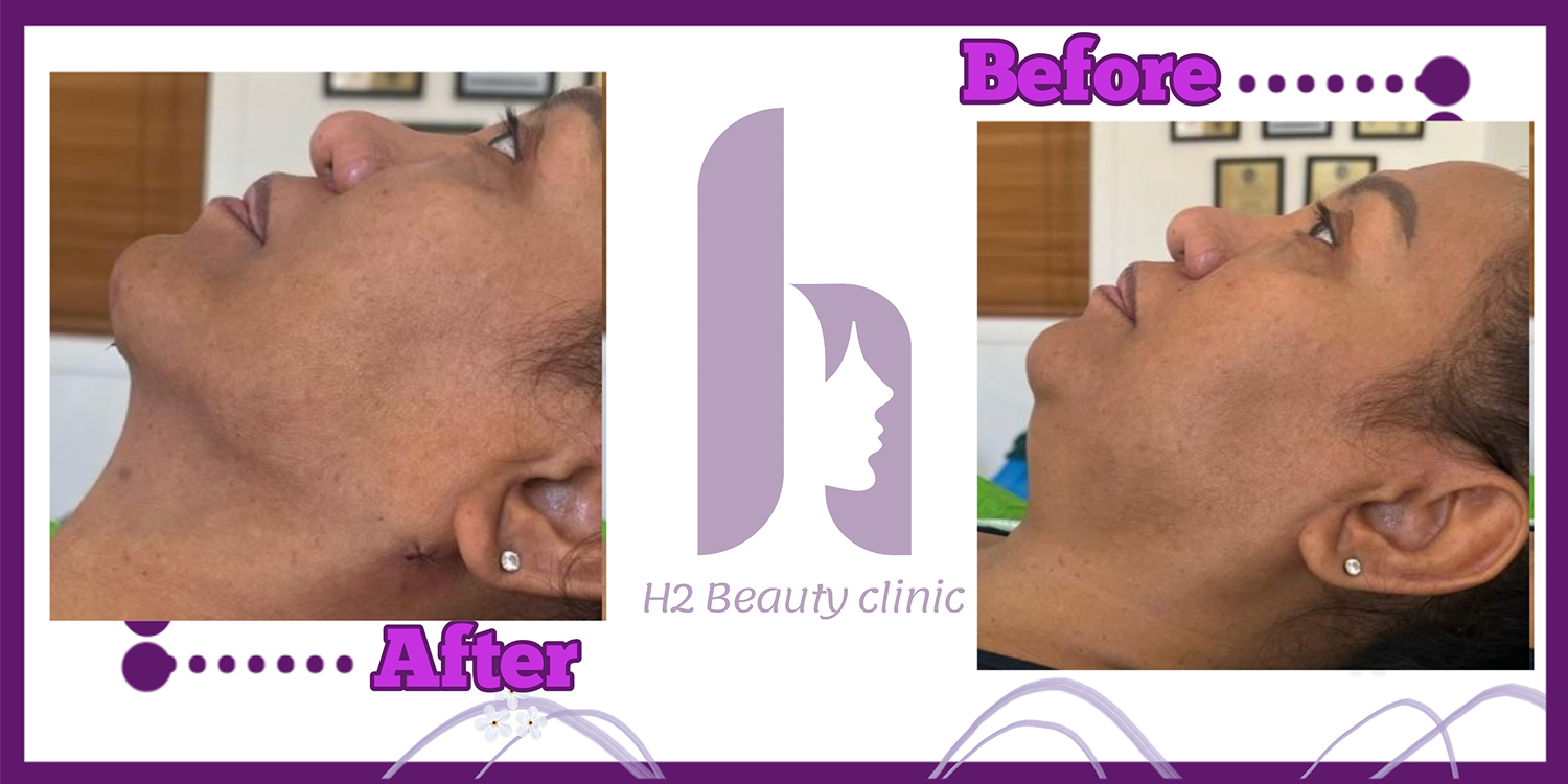 Clinic H2 submental liposuction comparison four; provider labels after on the left and before on the right