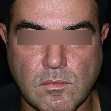 Before buccal fat removal, provider-published Dr Arash Najaf Beygi case