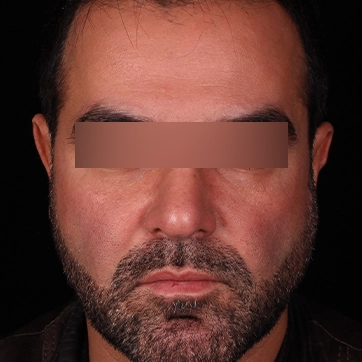 After buccal fat removal, provider-published Dr Arash Najaf Beygi case