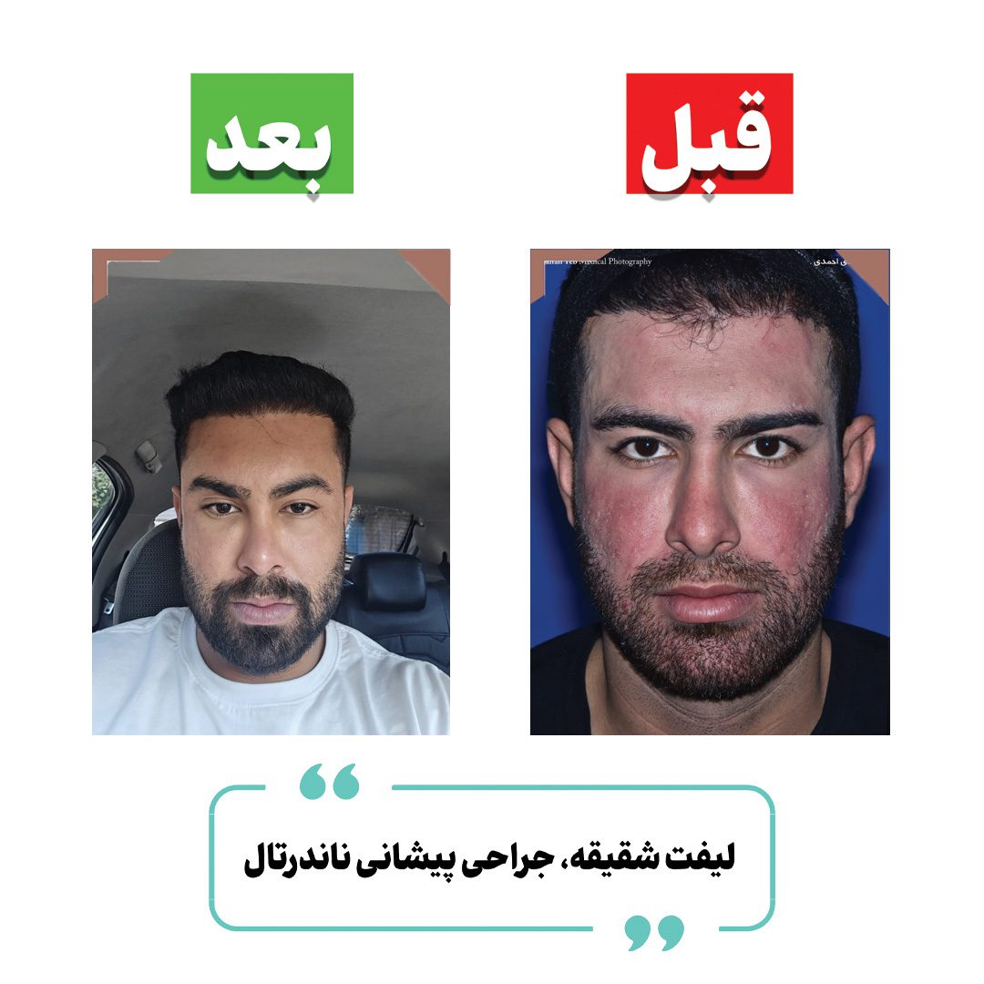 Combined temporal lift and forehead contouring before and after case published by Dr Mehdi Ahmadi