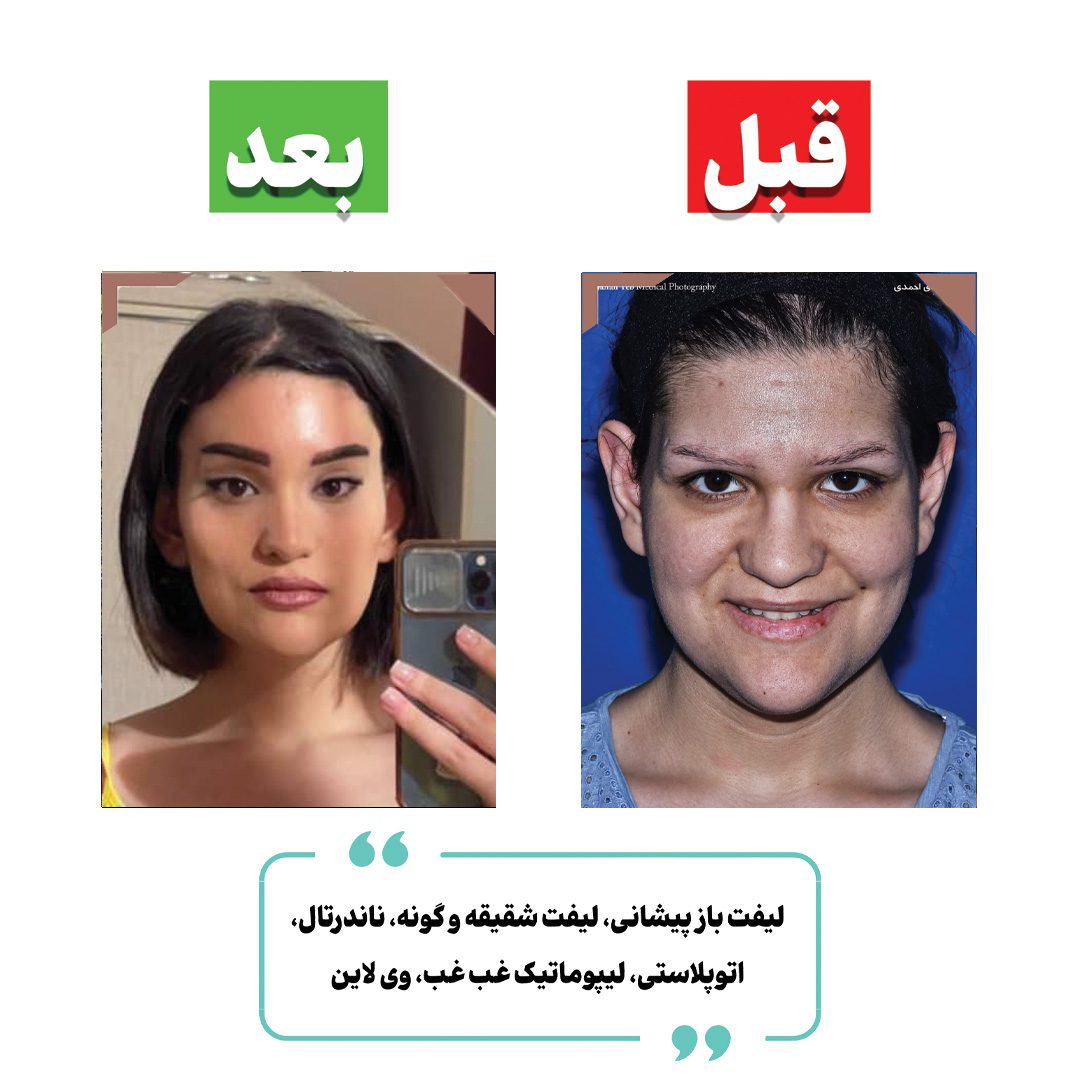 Combined temporal and endoscopic lift before and after case published by Dr Mehdi Ahmadi