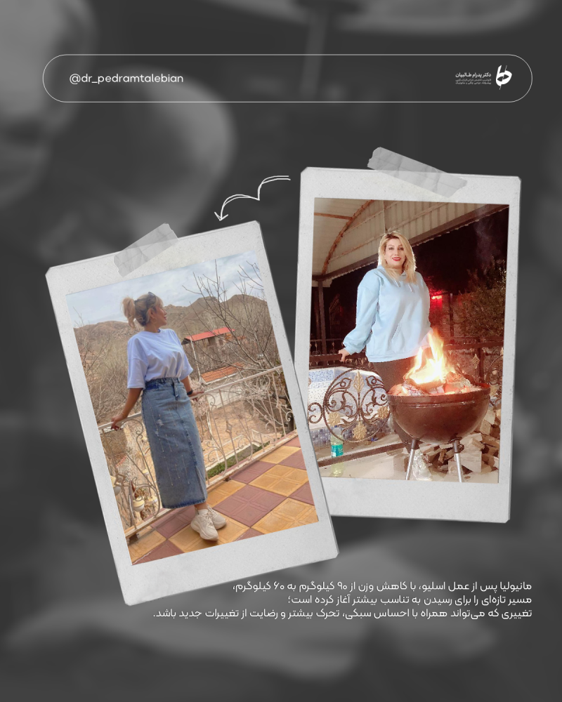 Provider-published weight-loss before and after example 17 from Dr Pedram Talebian