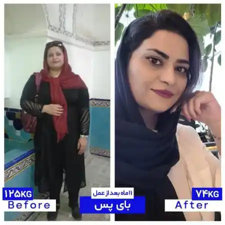 Provider-published weight-loss before and after example 20 from Dr Saeed Shams Nosrati