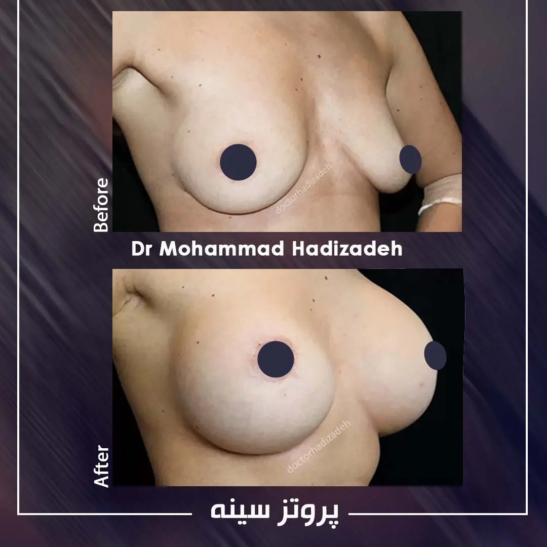 Side-by-side clinical photographs labelled before and after breast implant surgery, published by Dr Mohammad Hadizadeh