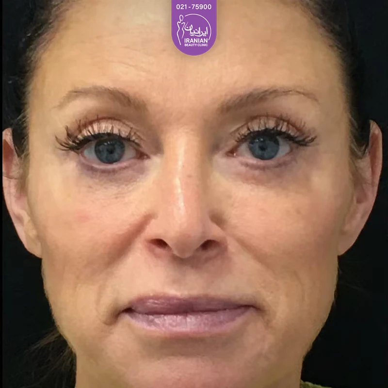 Iranian Clinic case 1: after eyelid surgery