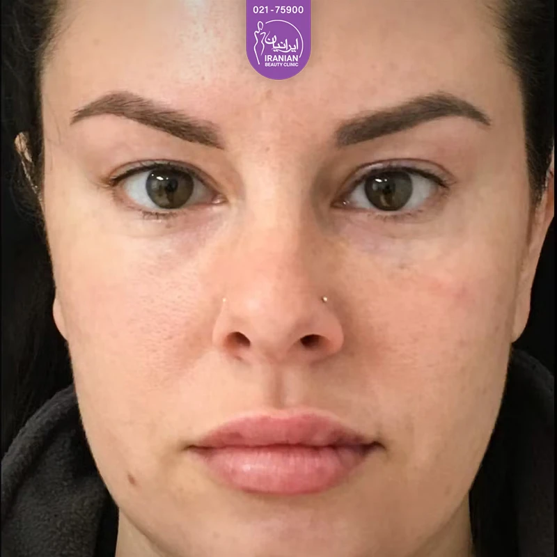 Iranian Clinic case 2: after eyelid surgery