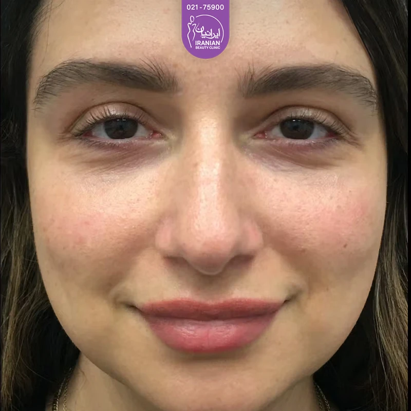 Iranian Clinic case 3: after eyelid surgery