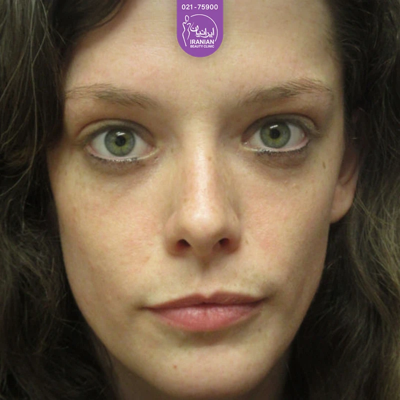 Iranian Clinic case 4: after eyelid surgery
