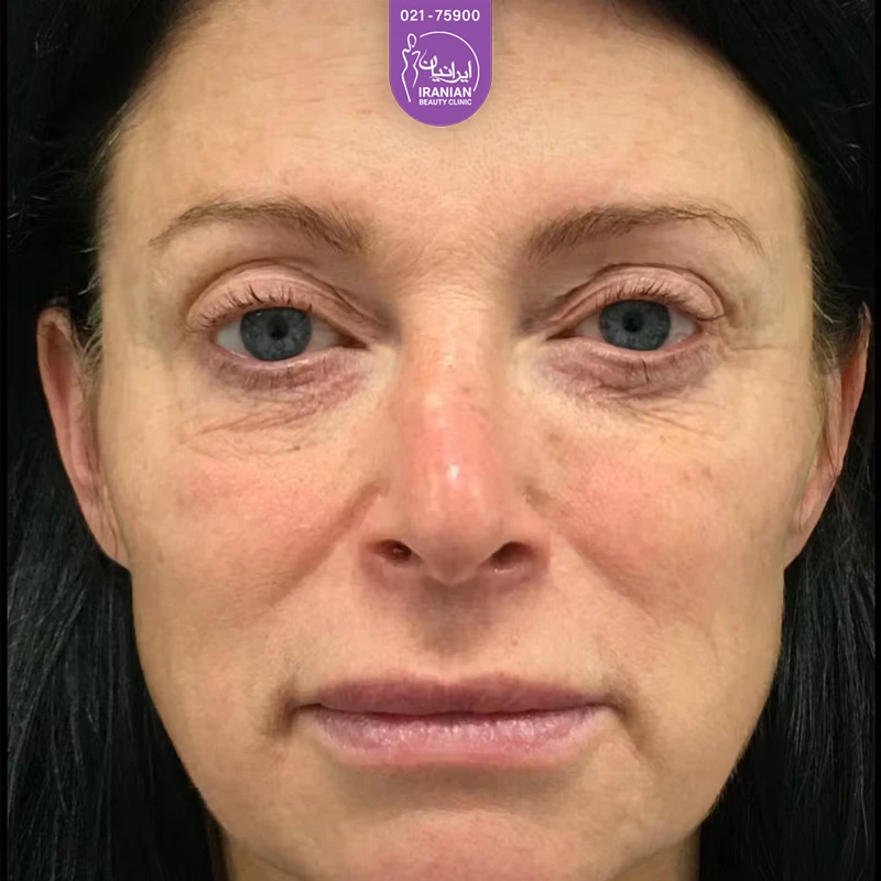 Iranian Clinic case 1: before eyelid surgery