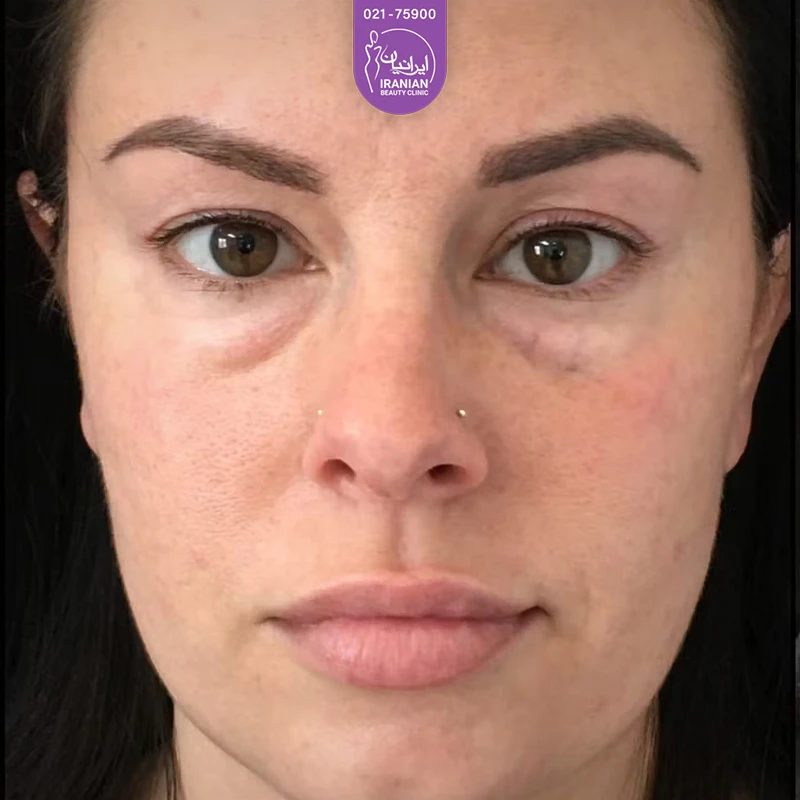 Iranian Clinic case 2: before eyelid surgery