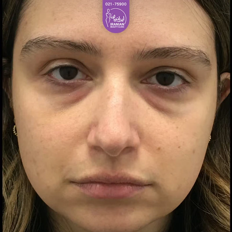 Iranian Clinic case 3: before eyelid surgery