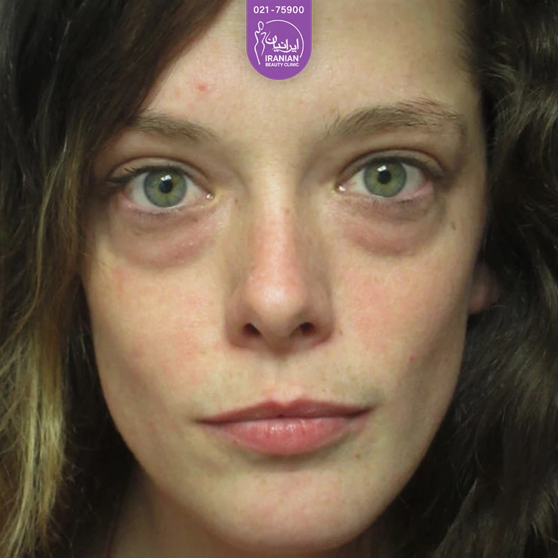 Iranian Clinic case 4: before eyelid surgery