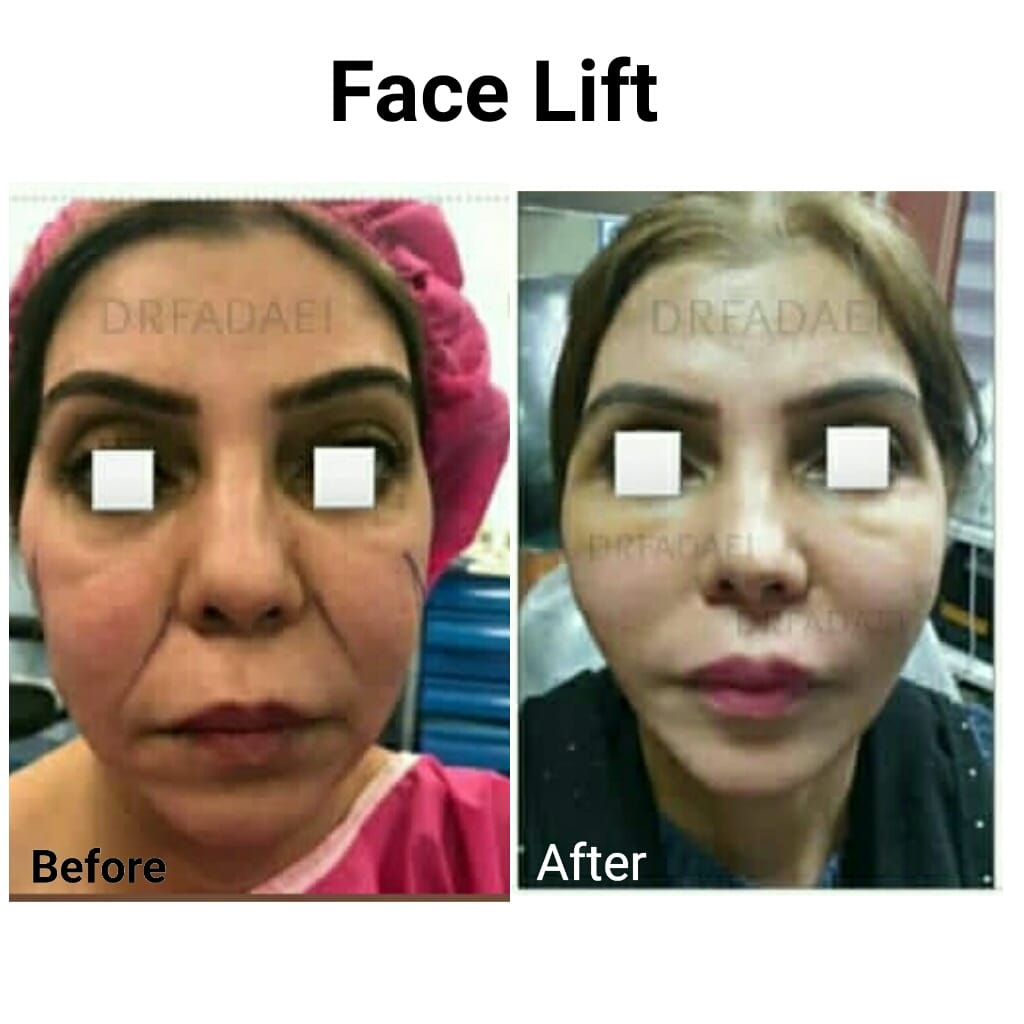 Facelift comparison, case 1 before and after, Dr Mohsen Fadaee