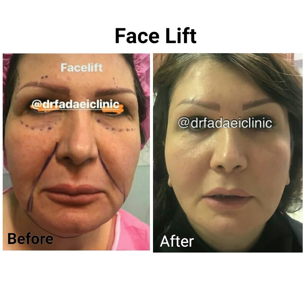 Facelift comparison, case 2 before and after, Dr Mohsen Fadaee