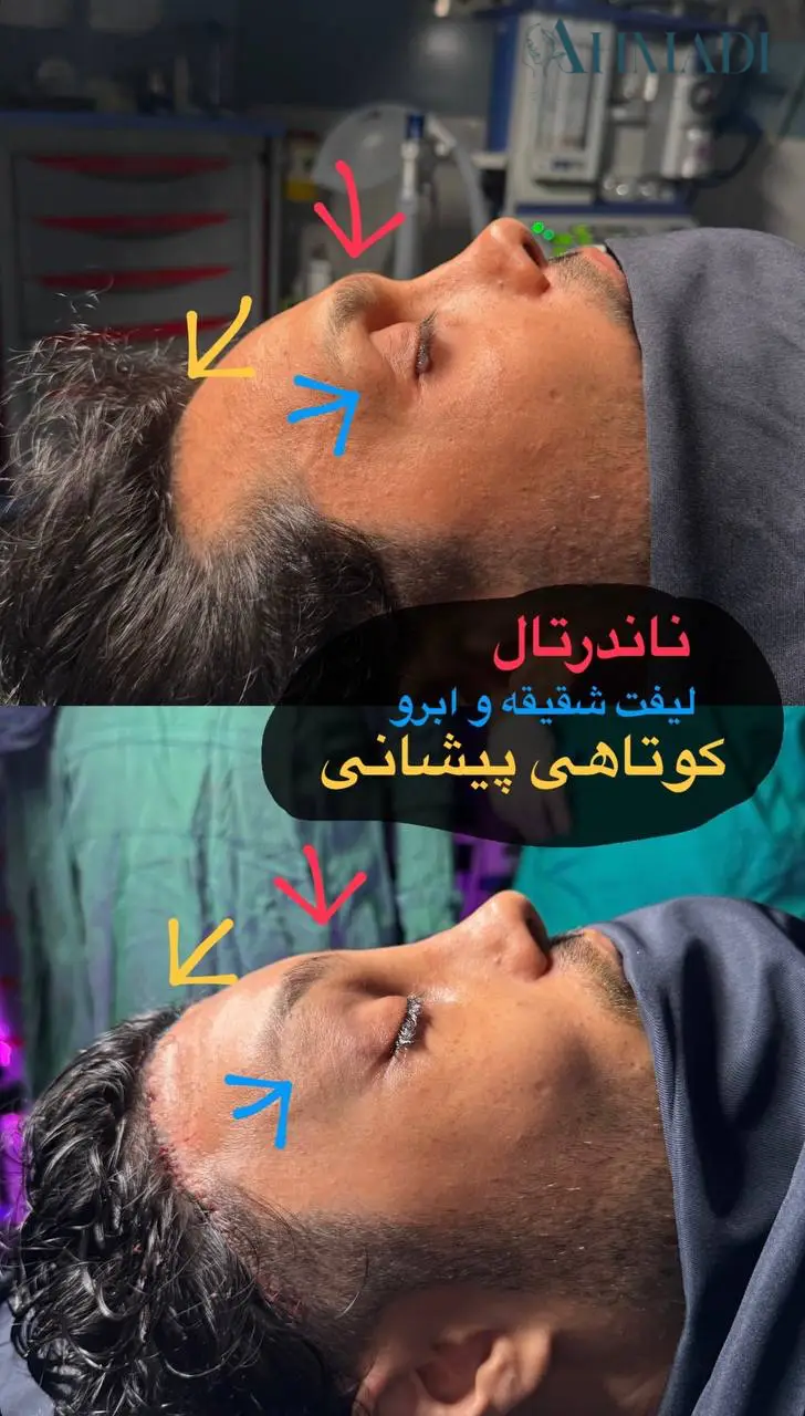 Before and after combined forehead bone contouring, brow and temple lift, and hairline shortening