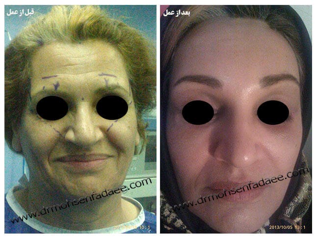 Before and after brow and forehead lift example published by Dr Mohsen Fadaee