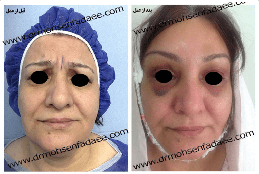 Before and after brow and forehead lift example from Dr Mohsen Fadaee's gallery