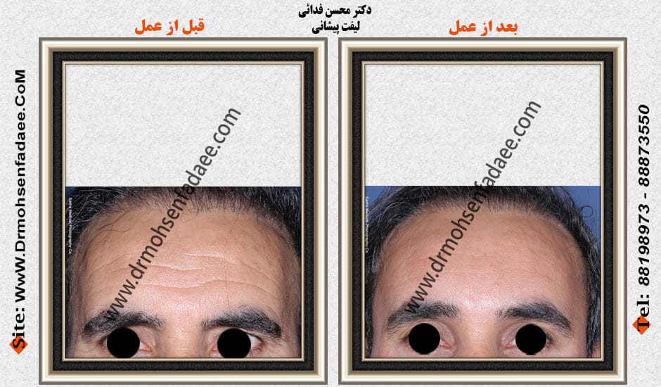 Before and after forehead lift, first view of a case published by Dr Mohsen Fadaee