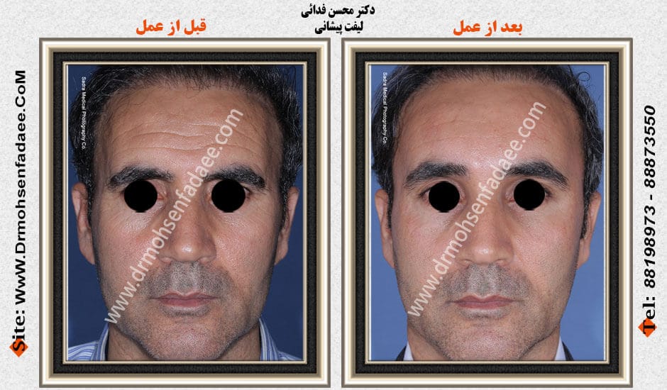 Before and after forehead lift, second view of the same case published by Dr Mohsen Fadaee