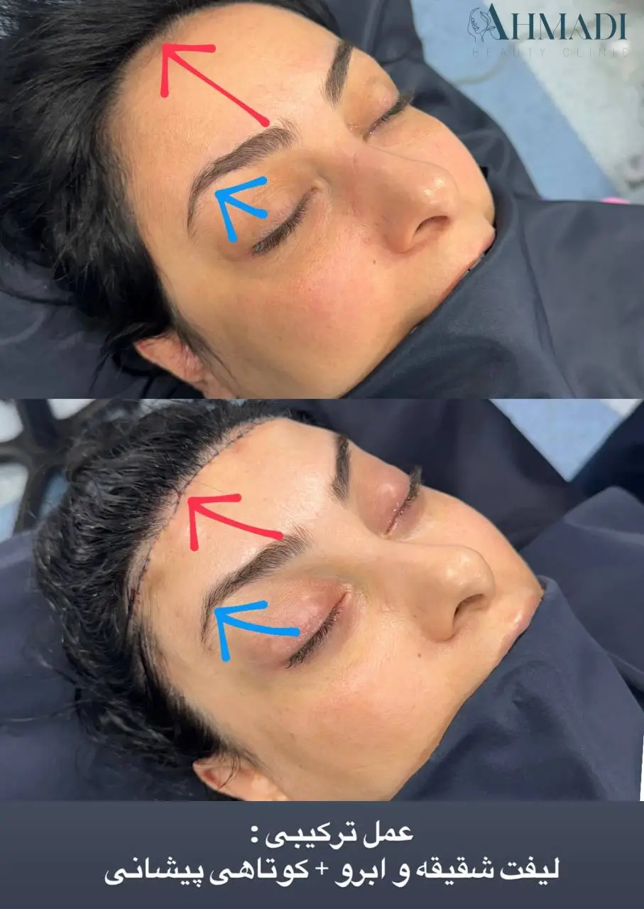 Before and after combined brow and temple lift with forehead shortening published by Dr Mehdi Ahmadi
