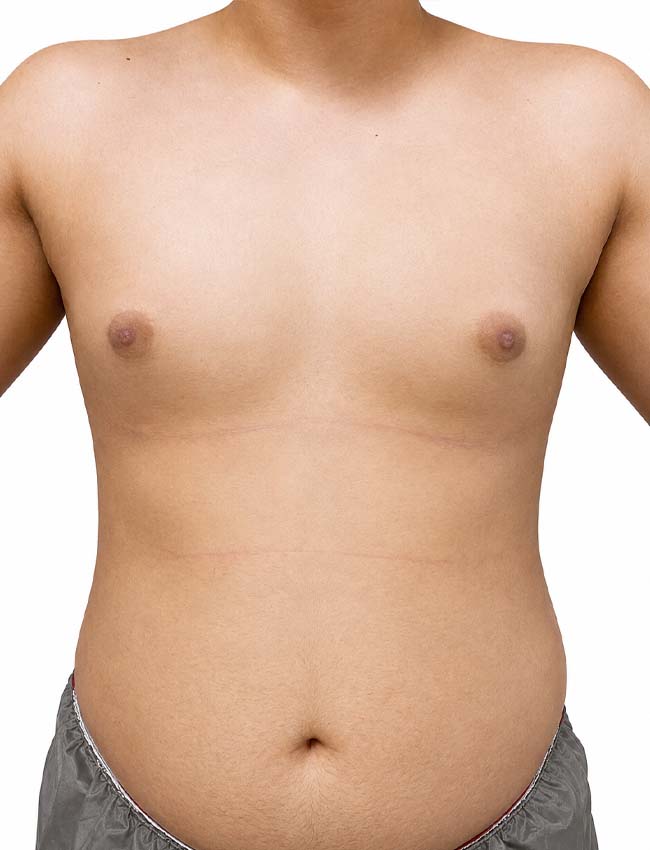 Male gynecomastia surgery after treatment, Dr Alireza Ghaseminejad