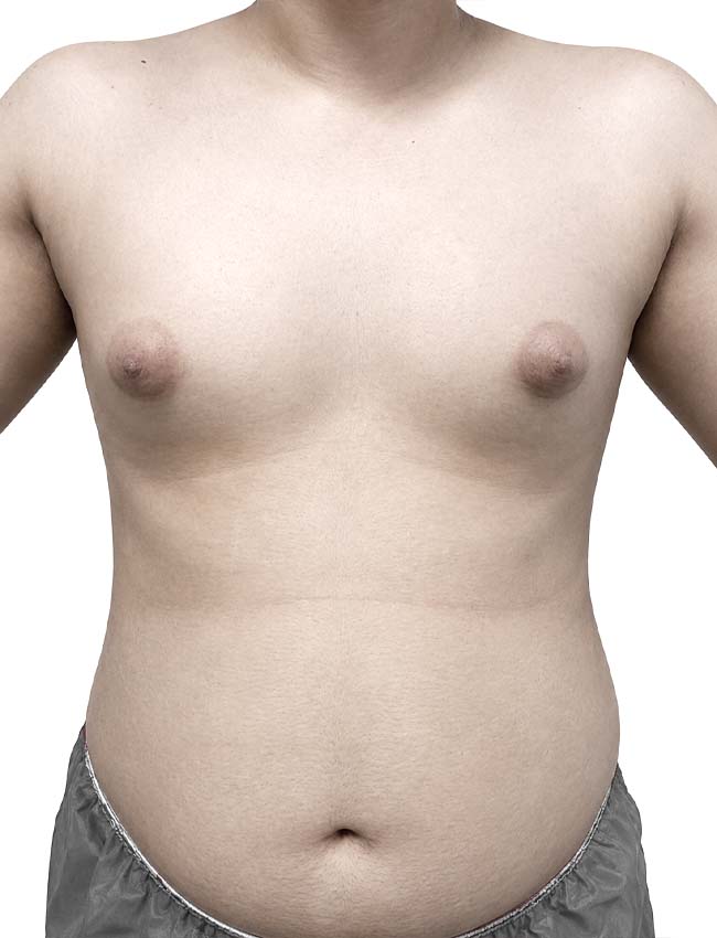 Male gynecomastia surgery before treatment, Dr Alireza Ghaseminejad