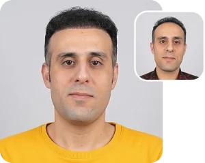 Scalp transplant composite photograph, case FK-1, source: Fakhraei Clinic