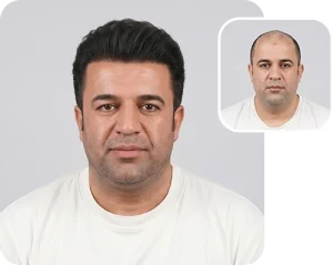 Scalp transplant composite photograph, case FK-7, source: Fakhraei Clinic