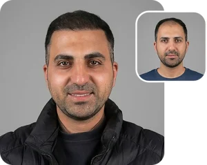 Scalp transplant composite photograph, case FK-11, source: Fakhraei Clinic