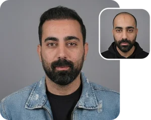 Scalp transplant composite photograph, case FK-12, source: Fakhraei Clinic