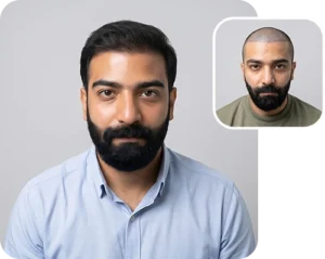 Scalp transplant composite photograph, case FK-14, source: Fakhraei Clinic