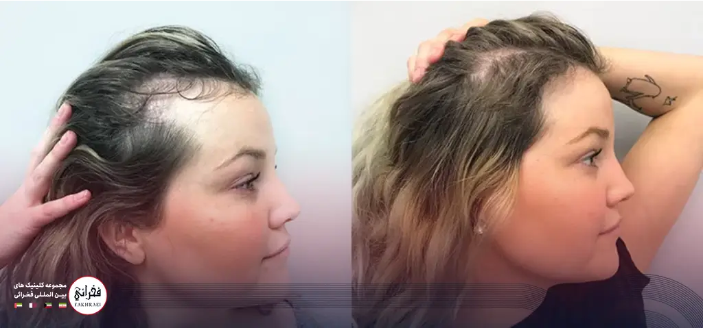 Women’s scalp transplant composite photograph, case FK-W1, source: Fakhraei Clinic