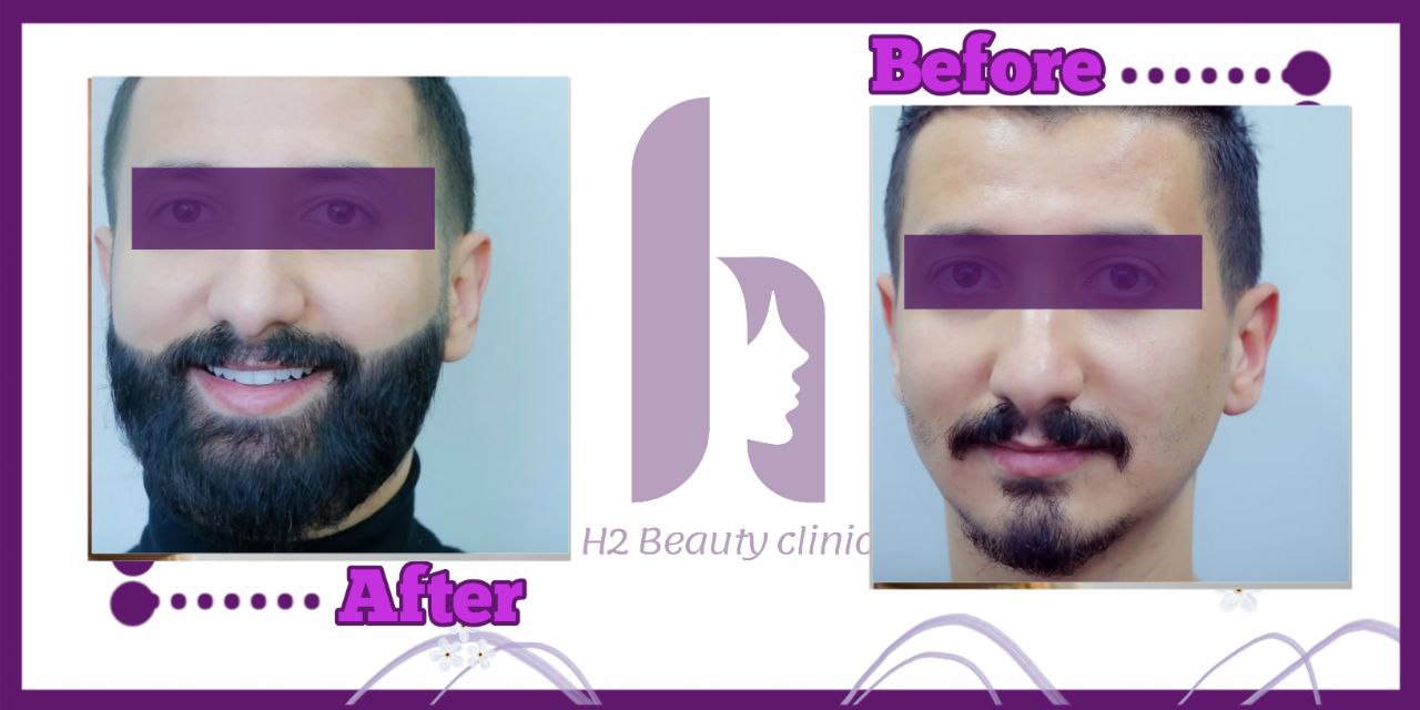 Beard transplant composite photograph, case H2-Beard-1, source: Clinic H2