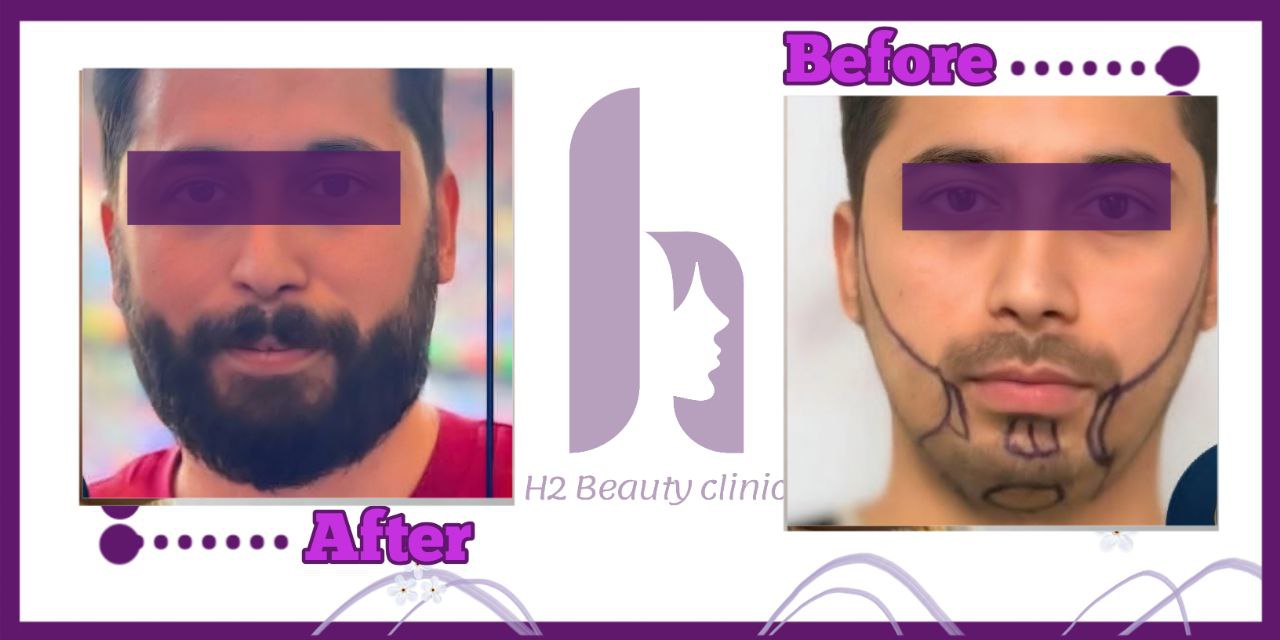 Beard transplant composite photograph, case H2-Beard-2, source: Clinic H2