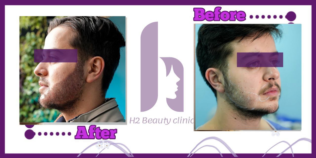Beard transplant composite photograph, case H2-Beard-3, source: Clinic H2