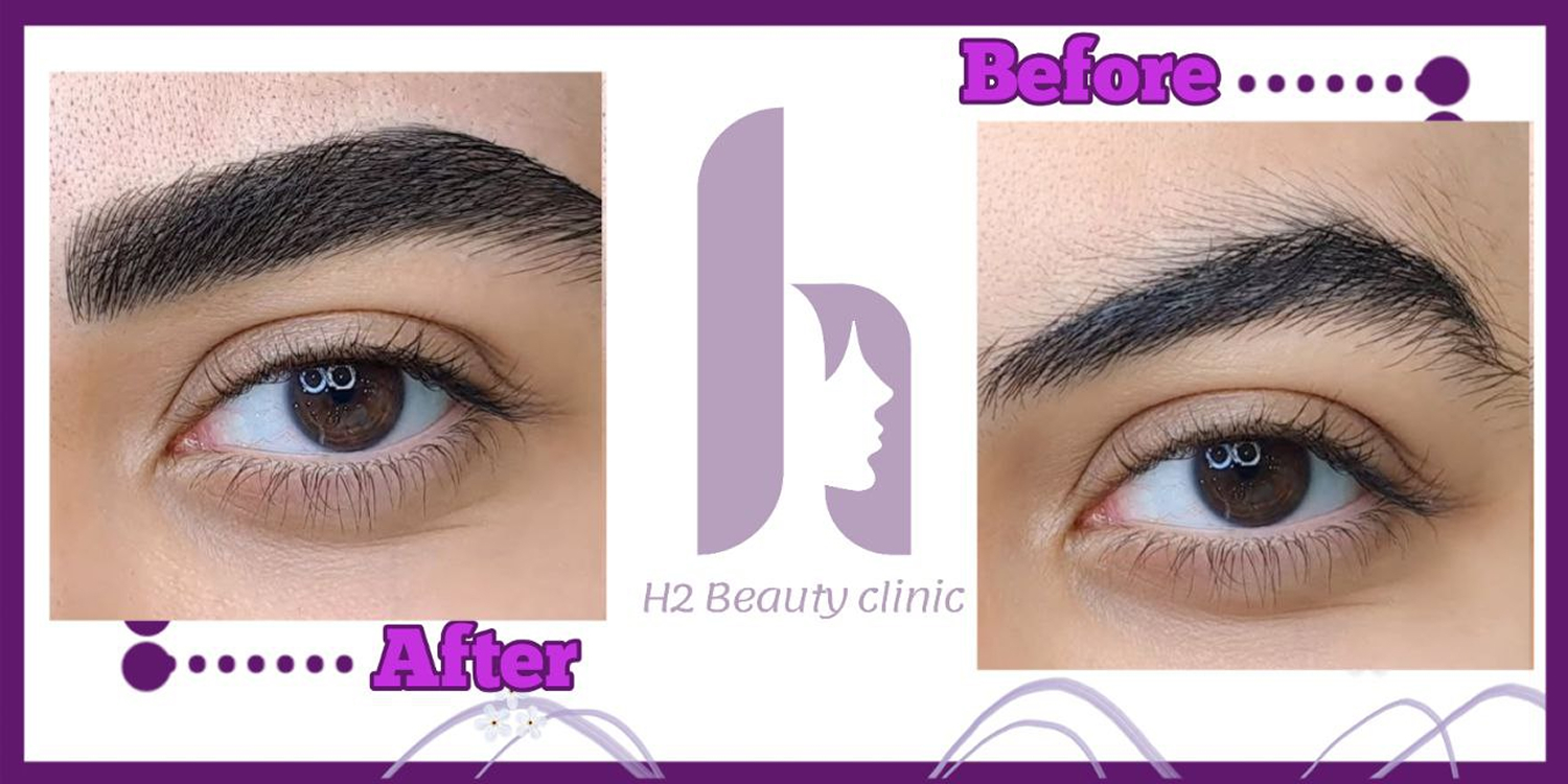 Eyebrow transplant composite photograph, case H2-Eyebrow-1, source: Clinic H2